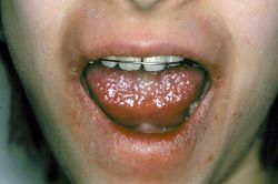Fémallergia jelei a szájban és a száj körül